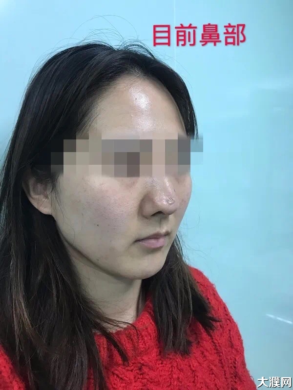 濮阳一女士鼻内竟被偷放"假体",最后溃烂穿孔.